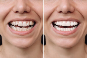Clear Aligners Before After