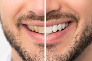 Tooth whitening